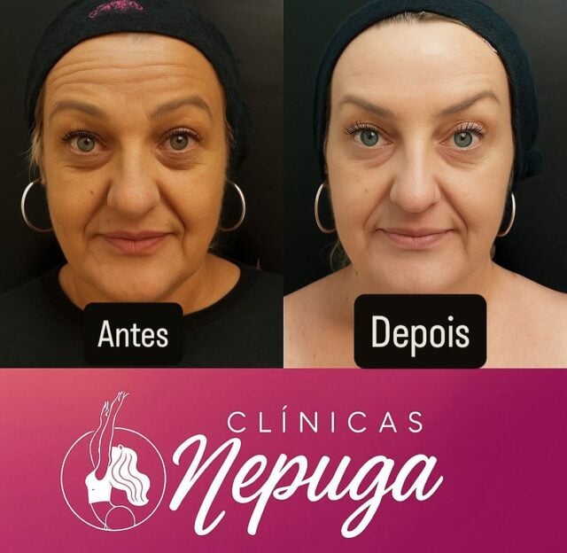 ✨ Antes e Depois da Elisa na Clínica Nepuga®️ ✨

Com o procedimento de Toxina Botulínica, Elisa conquistou mais do que um rosto rejuvenescido: ela resgatou sua autoestima, se sentiu mais confiante e viu sua produtividade aumentar no trabalho e na vida pessoal. 💼💖

Beleza que transforma de dentro pra fora.
Agende sua avaliação na Nepuga®️ e viva essa mudança também!

#ClínicaNepuga #Botox #Autoestima #Rejuvenescimento #AntesEDepois #BelezaComPropósito #moema #mooca #analiafranco #tatuapé
