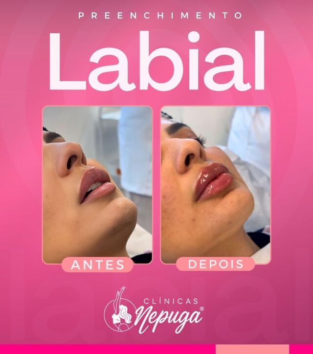 ✨ O Preenchimento Labial é a escolha das mulheres que querem realçar sua beleza de forma natural, sem exageros.
Agora é a sua vez de conquistar lábios mais volumosos, simétricos e marcantes – do jeitinho que sempre sonhou!

👄 Por que escolher a Clínica Nepuga®️?
✔️ Referência nacional em Harmonização Orofacial;
✔️ Equipe altamente capacitada, com profissionais atualizados nas melhores técnicas do mercado;
✔️ Ambiente seguro, higienizado e com estrutura premium;
✔️ Atendimento humanizado e avaliação individualizada;
✔️ Resultados naturais e personalizados para cada tipo de rosto.

📍Atendimento exclusivo em São Paulo!
💼 Vagas limitadas para o procedimento de preenchimento labial!

📲 Fale agora com nossa equipe e agende sua avaliação:
👉 11 91031-1435

Na Clínica Nepuga®️, você não faz só um procedimento. Você investe na sua autoestima com segurança, técnica e excelência. 💕

#saopaulo #sp #analiafranco #tatuape