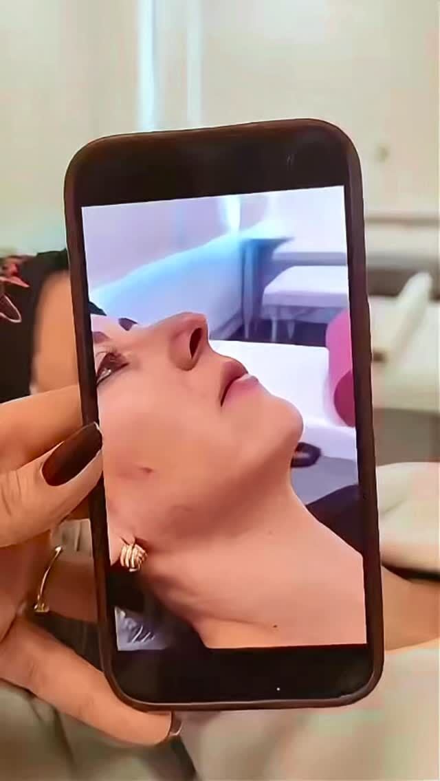 Você fez preenchimento labial e esse foi o resultado: autoestima lá em cima! 💋
Confiança renovada, sorriso mais leve e aquele toque de poder que só quem se ama de verdade entende.

#PreenchimentoLabial #AutoestimaRenovada #BelezaComPropósito #HarmonizaçãoFacial #ConfiançaQueTransforma