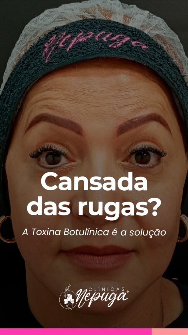Cansada das rugas? 😔 
A Toxina Botulínica é a solução que você busca! Além de suavizar as linhas de expressão existentes, ela previne que novas marcas se formem, mantendo sua pele com aspecto mais jovem e natural.

Quer uma pele mais lisa e radiante? Clique no link da bio e agende sua consulta para um antes e depois que vai te surpreender!

#ToxinaBotulinica #Rejuvenescimento #PeleJovem #ClinicasNepuga #DraAnaCarolinaPuga #EsteticaFacial #AdeusRugas #BelezaNatural