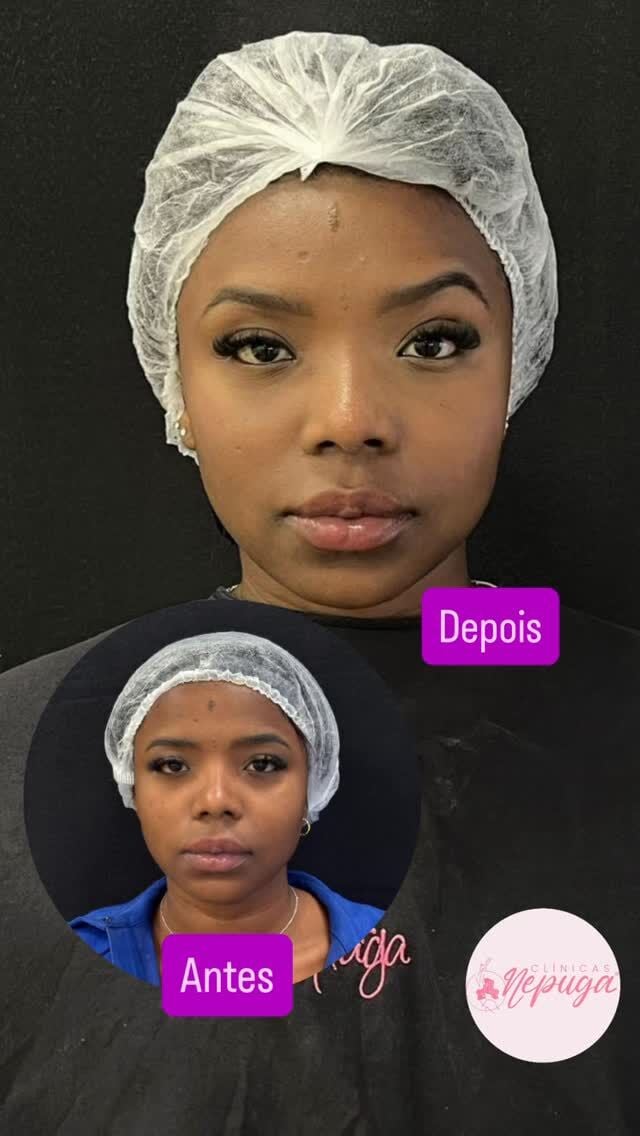 ✨ ANTES E DEPOIS DE UMA NOVA MULHER ✨
Essa é Bruna Francisca. Por fora, uma transformação impressionante.
Por dentro? Uma revolução completa.

Bruna chegou até a Clínica Nepuga®️ em busca de mais harmonia facial… mas o que ela realmente encontrou foi confiança, autoestima e o poder de se olhar no espelho e se reconhecer — e se admirar — novamente.

👩‍🔬 Uma abordagem inovadora de preenchimento facial com resultados naturais, progressivos e seguros, desenvolvida por especialistas da Nepuga®️ e aprovada pela Anvisa.

💼 Nas mãos de profissionais altamente renomados em harmonização orofacial, Bruna experimentou mais do que uma mudança estética.
Ela renasceu para a melhor versão de si mesma.

Hoje, Bruna sorri com mais liberdade, se expressa com mais leveza e vive com mais segurança.

E você, está esperando o quê para viver sua transformação?

📍 Agende sua avaliação personalizada na unidade Nepuga®️ São Paulo
📲 WhatsApp: 11 91031-1435
🌟 Vagas limitadas!

#saopaulo #sp #sãopaulo #itaim #moema #tatuape #analiafrancotatuapé