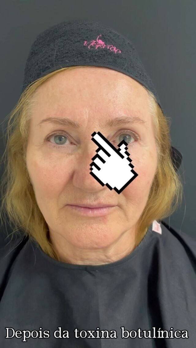 👉🏻Mais um resultado de excelência com nossos profissionais altamente capacitados!

❤️Essa paciente tem em torno 50 anos de idade, e olhem a diferença e o PODER da toxina botulínica, mesmo com rugas ainda profundas👏🏻

#toxinabotulinica #botox #estetica #biomedicinaestetica #clinicasnepuga #belezaesaude #draanacarolinapuga #enfermagemestetica