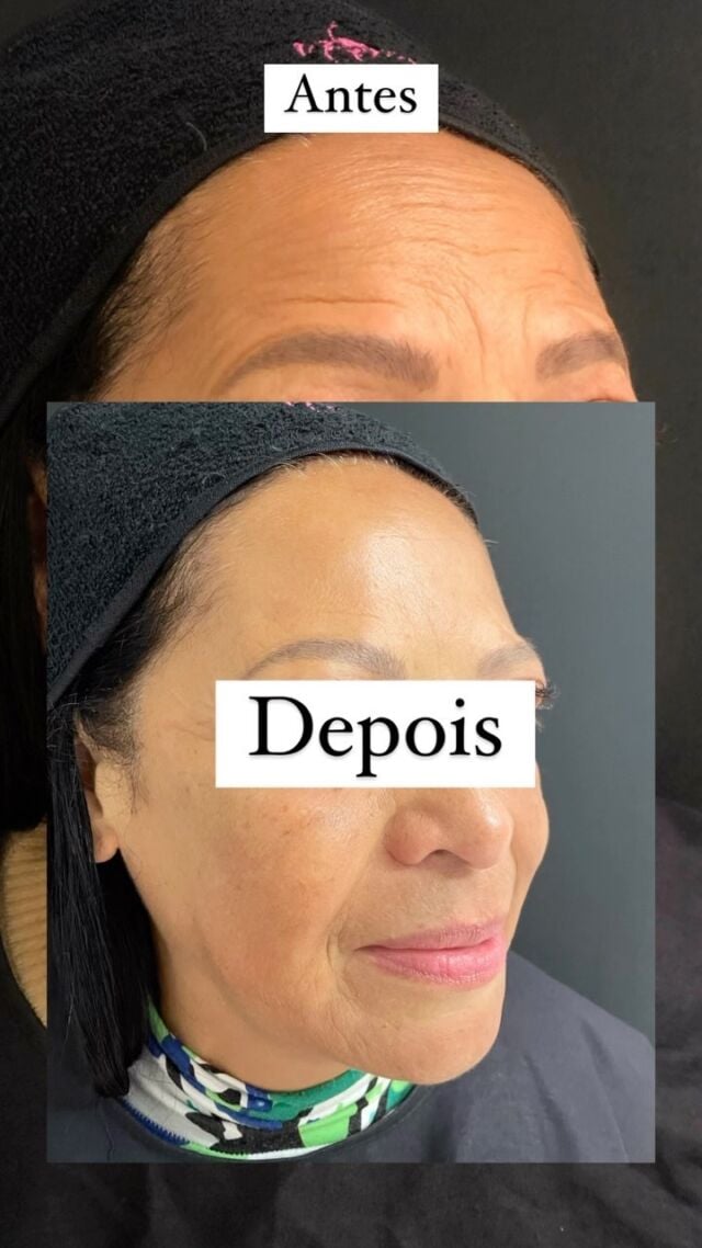 ✨Nossas pacientes tem ficado cada vez mais satisfeitas e super contentes com o incrível resultado que a toxina botulínica proporciona!

👏🏻-rugas;
👏🏻-linhas de expressão;
👏🏻auto estima RENOVADA!

🥰Agende uma consulta conosco e sinta-se à vontade para tirar todas as suas dúvidas sobre os nossos procedimentos💕

#toxinabotulinica #biomedicina #biomedicinaestetica #enfermagemestetica #saudeebemestar #saudeebeleza #clinicasnepuga #botox #autoestima