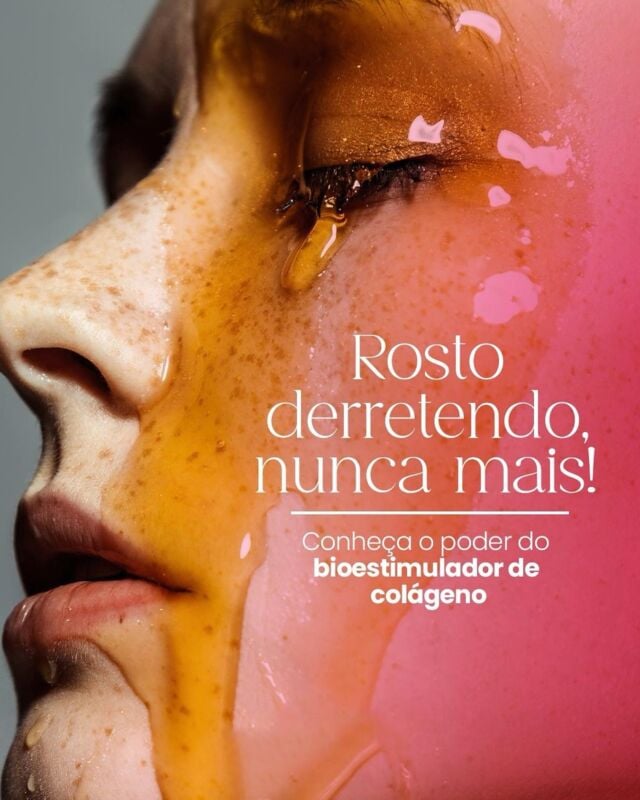 Dê tchau ao rosto derretido! 🫠

Com o poder do bioestimulador de colágeno, nós trazemos a solução para um rejuvenescimento facial sem igual.

Este tratamento não apenas
restaura a firmeza e elasticidade da pele, mas também estimula a produção natural de colágeno, resultando em um visual naturalmente jovem e radiante.

Quer saber mais? Entre em contato com a nossa equipe!