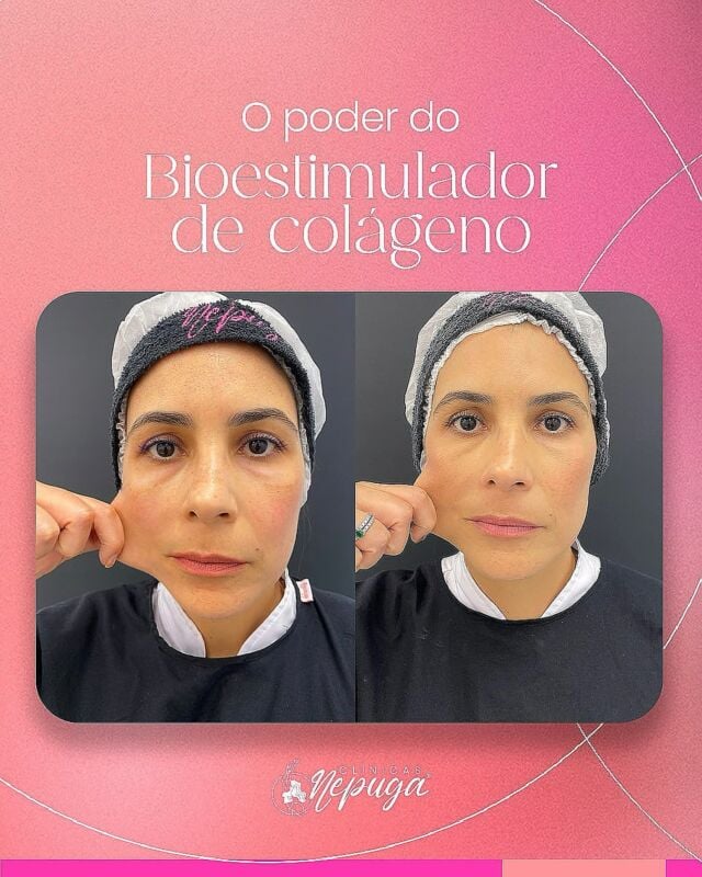 Mais do que uma mudança visível, é uma transformação na firmeza, textura e viço da pele — com naturalidade e resultados progressivos.

O antes e depois fala por si: pele mais jovem, revitalizada e cheia de vida!
Ideal para quem busca prevenção e rejuvenescimento sem exageros.

#BioestimuladorDeColágeno #RejuvenescimentoNatural #AntesEDepois #EstéticaComPropósito #PeleFirme #ResultadosReais

*Esta imagem não representa, em hipótese alguma, garantia de resultado. Cada ser humano tem características anatômicas e fisiológicas únicas