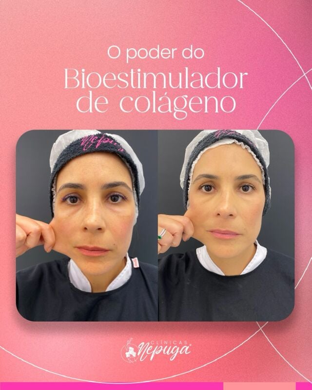 Mais do que uma mudança visível, é uma transformação na firmeza, textura e viço da pele — com naturalidade e resultados progressivos.

O antes e depois fala por si: pele mais jovem, revitalizada e cheia de vida!
Ideal para quem busca prevenção e rejuvenescimento sem exageros.

#BioestimuladorDeColágeno #RejuvenescimentoNatural #AntesEDepois #EstéticaComPropósito #PeleFirme #ResultadosReais

*Esta imagem não representa, em hipótese alguma, garantia de resultado. Cada ser humano tem características anatômicas e fisiológicas únicas