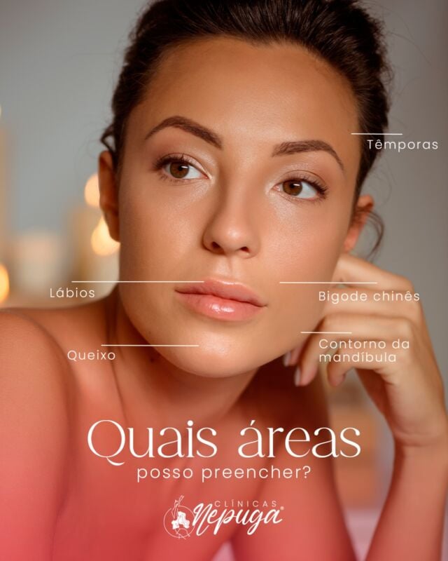 ✨ Uma pergunta que recebemos com frequência é: “Em quais áreas do meu rosto posso fazer preenchimento?”
⠀
A resposta é: em várias! Cada região tem uma função estética e estrutural diferente — e o segredo está na harmonização, não no exagero.
⠀
Entre as áreas mais comuns estão:
👃 Sulcos nasogenianos (famosos “bigode chinês”)
👄 Lábios
😮 Queixo
🧏 Mandíbula
🧠 Têmporas

⠀
Cada caso é único, e a indicação depende do seu formato facial, da sua idade e, claro, do seu objetivo.
⠀
Tem vontade de preencher alguma região do rosto? Me conta aqui nos comentários! 💬👇

#PreenchimentoFacial #HarmonizaçãoFacial #EstéticaComSegurança #AutoestimaEmDia #BiomedicinaEstética
