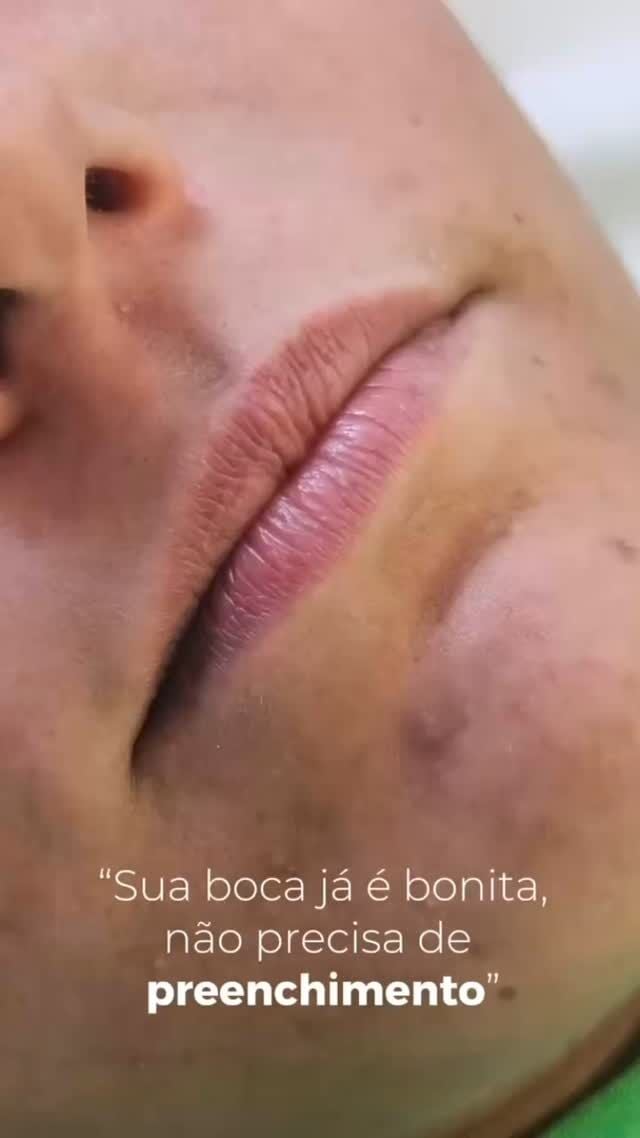 Preenchimento labial vai muito além de volume!

Na verdade, ele é o toque de sofisticação que realça o contorno, hidrata profundamente, suaviza as linhas finas e traz aquele “up” que transforma o rosto com naturalidade e elegância.

Quer um bocão? Dá pra conquistar!
Mas se você já ama o tamanho dos seus lábios e só quer valorizar o que já tem, esse protocolo é pra você.

E o segredo? Não é só o produto, é a TÉCNICA certa para o seu rosto e é isso que você encontra aqui, nas Clínicas Nepuga. 💋

#PreenchimentoLabial #BelezaNatural #HarmonizaçãoFacial #ClinicasNepuga #EstéticaAvançada #LábiosPerfeitos

*Esta imagem não representa, em hipótese alguma, garantia de resultado. Cada ser humano tem características anatômicas e fisiológicas únicas