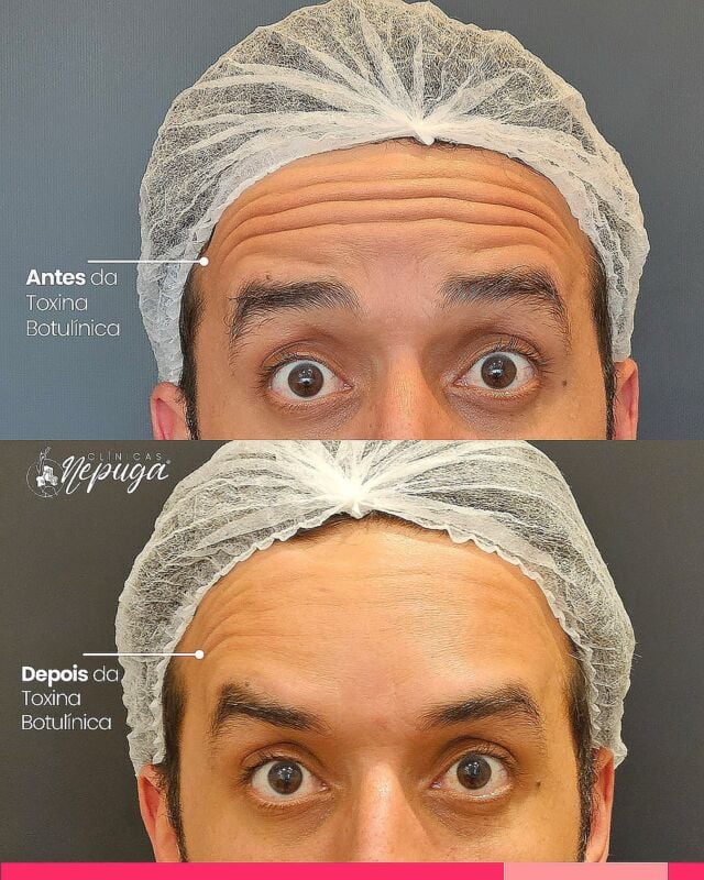 O antes e depois que você respeita!
A toxina botulínica suaviza rugas e linhas de expressão com naturalidade e eficácia.

💉O resultado final aparece entre 7 a 14 dias, revelando uma pele mais lisa, descansada e harmoniosa.

Quer rejuvenescer sem perder sua essência? Fale com a gente!

#Botox #ToxinaBotulinica #AntesEDepois #RugasSuavizadas #EstéticaComSegurança #BelezaNatural

*Esta imagem não representa, em hipótese alguma, garantia de resultado. Cada ser humano tem características anatômicas e fisiológicas únicas