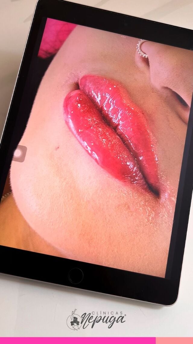 Lábios mais definidos, hidratados e com volume na medida certa!

O preenchimento labial realça sua beleza natural e valoriza o seu sorriso.

💉 Procedimento seguro, com resultado imediato e personalizado para você se sentir ainda mais confiante.

📍Agende sua avaliação!

#PreenchimentoLabial #BelezaNatural #HarmonizaçãoFacial #LábiosPerfeitos

*Esta imagem não representa, em hipótese alguma, garantia de resultado. Cada ser humano tem características anatômicas e fisiológicas únicas