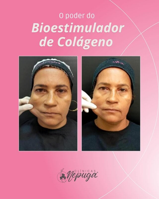 ✨ A beleza de se reencontrar com o espelho.
Na imagem, você vê o antes e depois de uma de nossas pacientes que decidiu se priorizar — e o resultado fala por si só.

💉 Com o bioestimulador de colágeno, ela não apenas rejuveneceu a pele, mas reacendeu a própria autoestima.

🌿 O procedimento é minimamente invasivo, seguro e promove uma transformação gradual e natural, devolvendo firmeza, viço e contorno ao rosto sem alterar sua essência.

💬 “Hoje me olho com orgulho. Me sinto mais confiante no trabalho, mais leve com as pessoas… mais eu.” – depoimento real de quem passou pela experiência na Clínica Nepuga®️.

📍 Agende sua avaliação e descubra como o bioestimulador pode revelar a sua melhor versão — com leveza, sem exageros.

📲 Chame no direct e comece hoje sua jornada de renovação.
Clínica Nepuga®️ – Estética de verdade. Resultados com alma.

#salvador #salvadorbahia #nepugasalvador